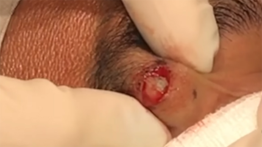 Puss filed pimple arouns anus brilliant phrase Can Puss filed pimple arouns anus