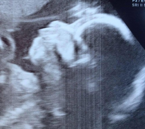 Baby Had So Much Hair It Showed Up On The Ultrasound