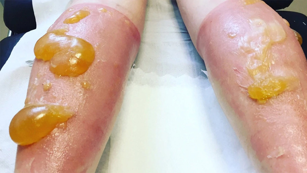 Julie Nisbet lying face-down as the gigantic orange blobs protrude from her calves. Photo / Julie Nisbet Twitter