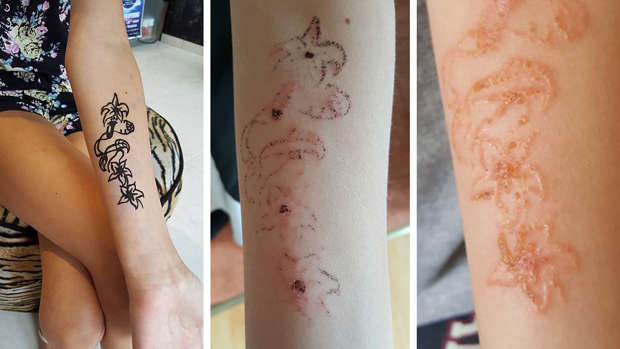 Girl could be scarred for life after black henna tattoo Girl could be scarred for life after black henna tattoo