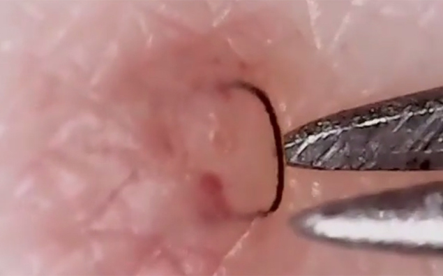 Move Over Dr Pimple Popper This Is Everyone S New Guilty Pleasure