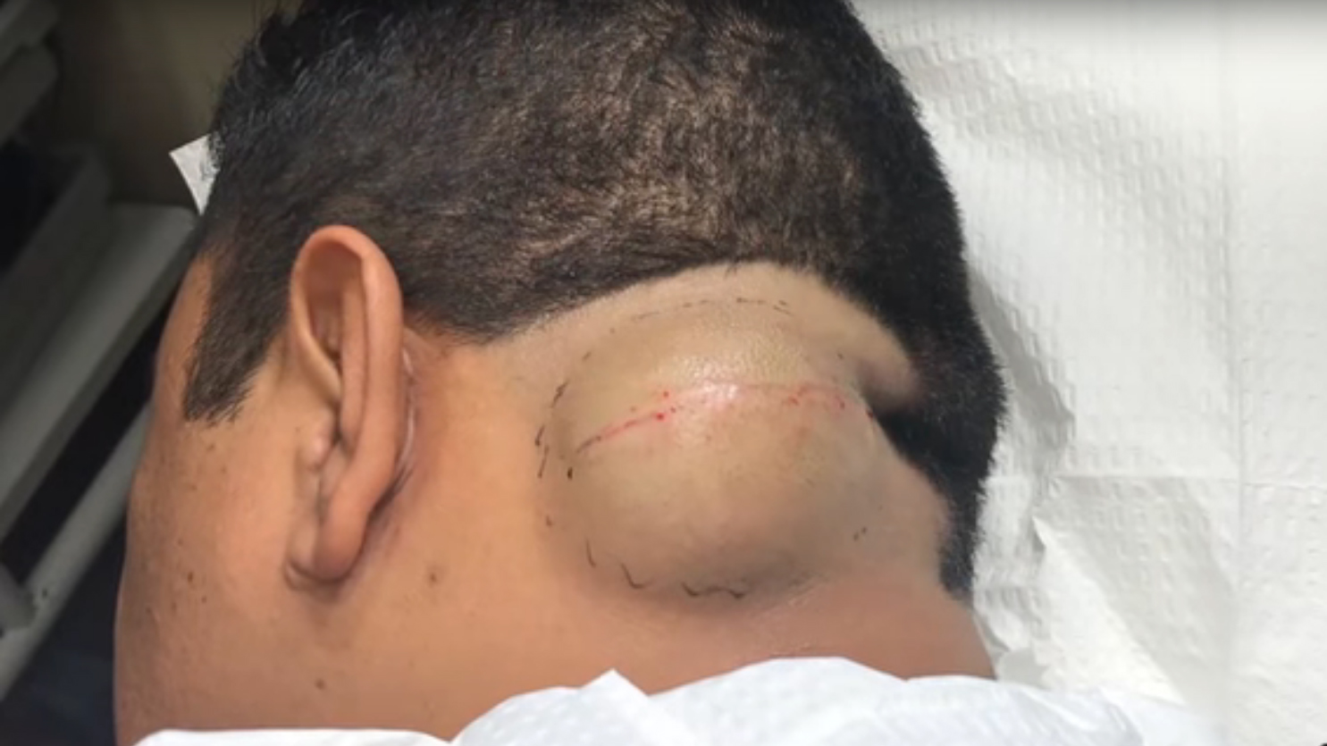 Dr Pimple Popper takes on an apple sized cyst - and it is DISGUSTING!