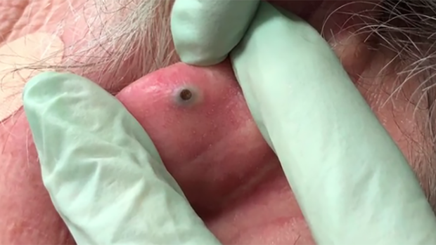 Dr Pimple Popper extracting this blackhead the size of a pebble is