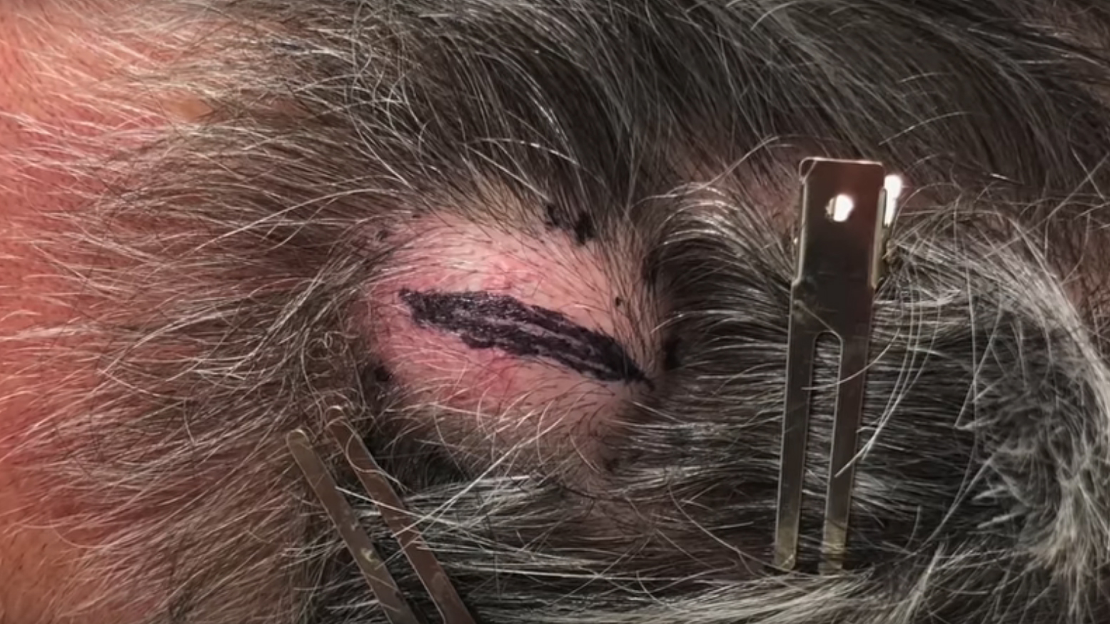 Dr Pimple Popper drains HUGE cyst that looks like an egg in gruesome footage