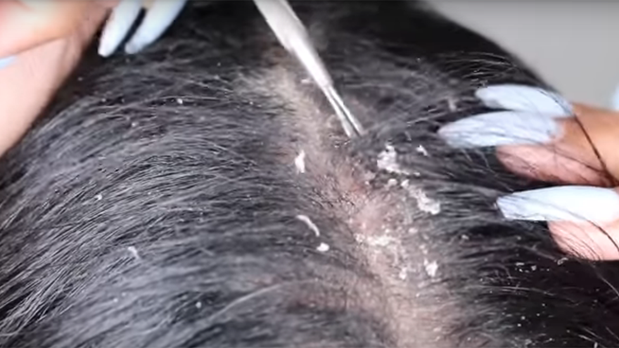 Move over pimple pops! There's a new gross video trend ... and it's dandruff scrapings!
