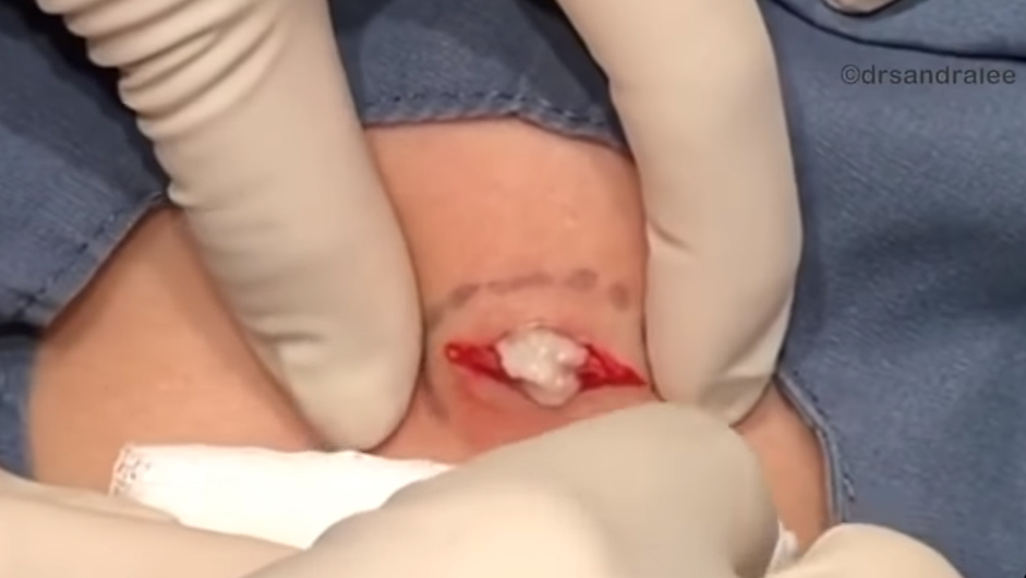 Dr Pimple Popper's latest cottage cheese pop is disgustingly satisfying