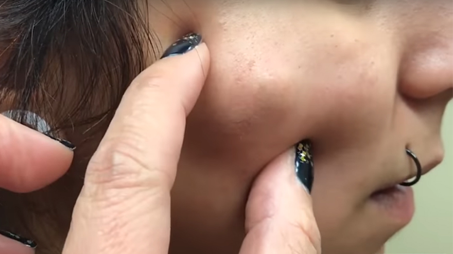 Dr Pimple Popper has shared her top 8 pops of all time ... and they are all totally gross!
