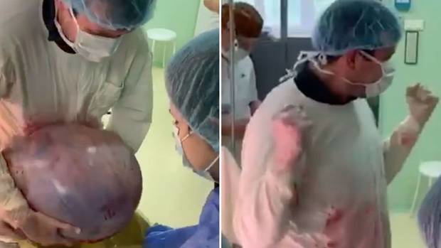 Doctors at City Clinical Hospital in Moscow remove an ovarian tumour weighing 25kg. Photo / Facebook / City Clinical Hospital