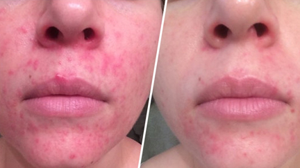 You won't believe what this lady used to clear up her acne...