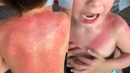 Warnings issued for Peppa Pig sunblock after boy is severely sunburnt