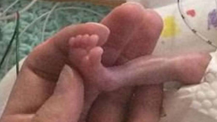 World's 'most premature baby' ever survives against all odds