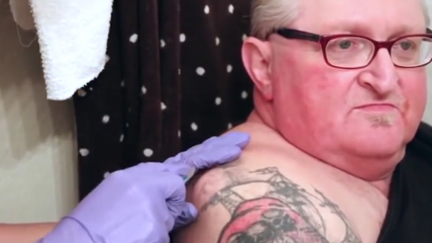 Watch the gruesome moment a man has a cyst popped that he's had since he was 16!