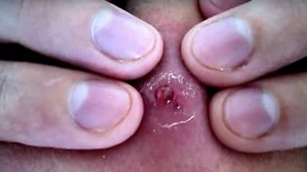 Is this pimple popping video is the most repulsive of all time?