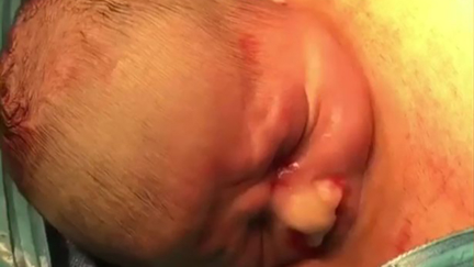 Incredible rare video of baby 'popping out' during caesarean is unlike anything you've ever seen!
