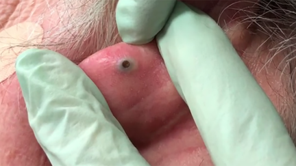 Dr Pimple Popper extracting this blackhead the size of a pebble is the most satisfying thing you'll see all week!