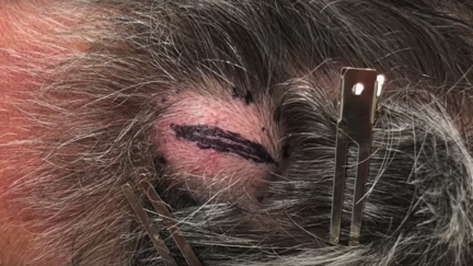 Dr Pimple Popper drains HUGE cyst that looks like an egg in gruesome footage