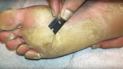 This foot callus removal is as equally disgusting and satisfying as pimple pops!