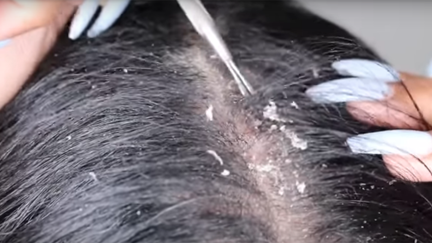 Move over pimple pops! There's a new gross video trend ... and it's dandruff scrapings!
