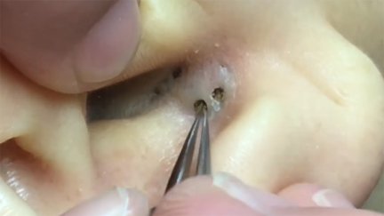 This gruesome double blackhead pop will absolutely make you squirm!