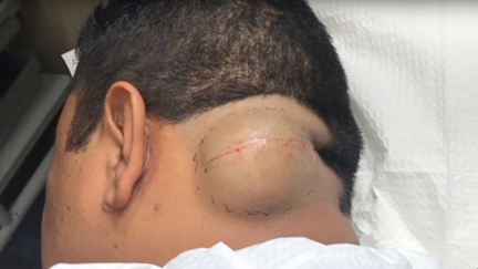 Dr Pimple Popper takes on an apple sized cyst - and it is next level DISGUSTING!