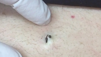 Dr Pimple Popper extracting this blackhead the size of a pebble is the most satisfying video!