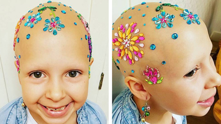 'I love being bald': Young girl with Alopecia embraces her condition in the most beautiful way