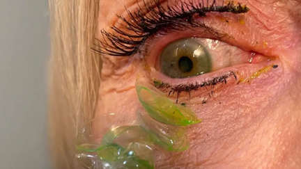 Watch the disturbing moment a doctor removes 23 contact lenses from a woman’s eye